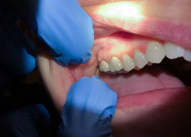 Best Emergency Broken Tooth Repair in Upper Lake, CA